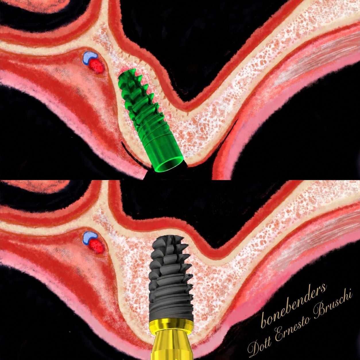 Sezione di un impianto inserito con tecnica Split Crest