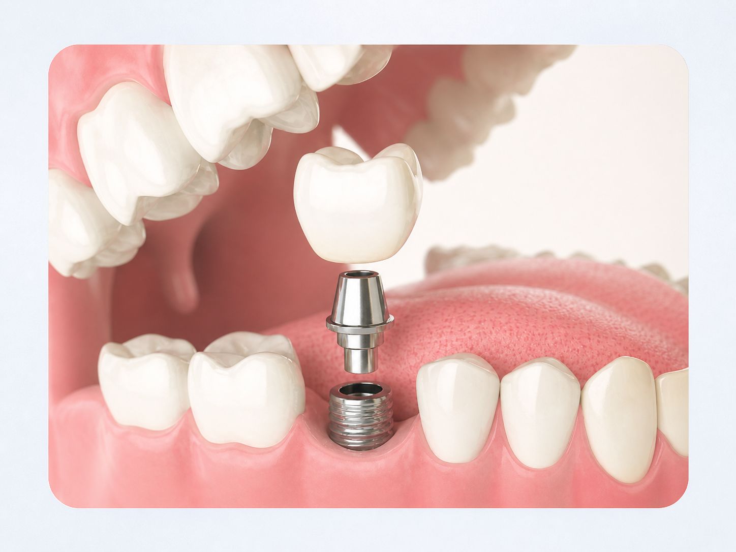 Impianto dentale singolo con corona protesica