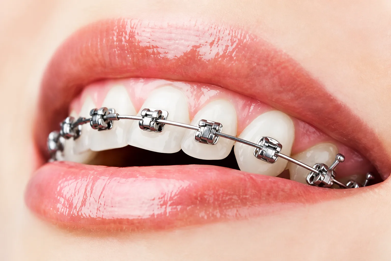 Sorriso con apparecchio ortodontico fisso