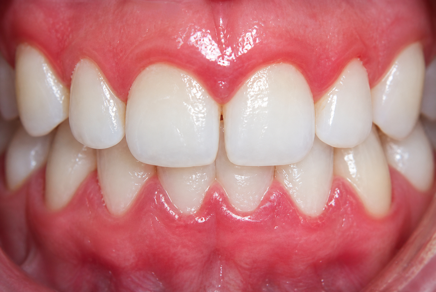 Dentatura ravvicinata con gengive sane e denti bianchi